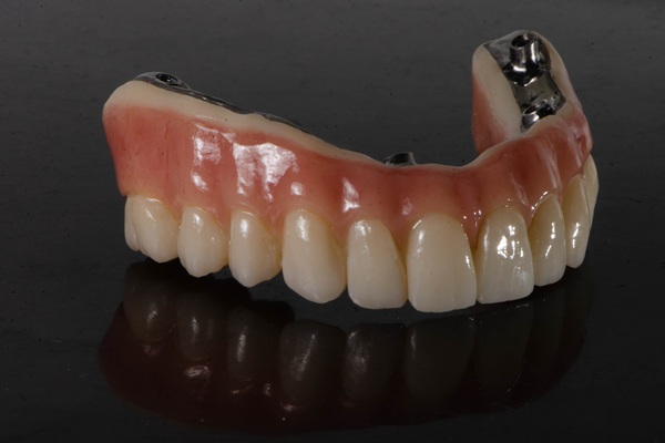 How All On   Is A Recommended Solution For Tooth Loss